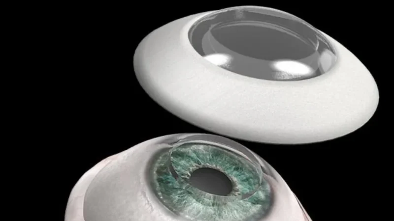 Paciente volta a enxergar após 10 anos com córnea sintética