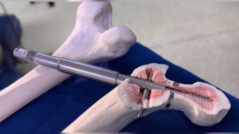 Implante inédito desenvolvido no Brasil melhora tratamento do fêmur