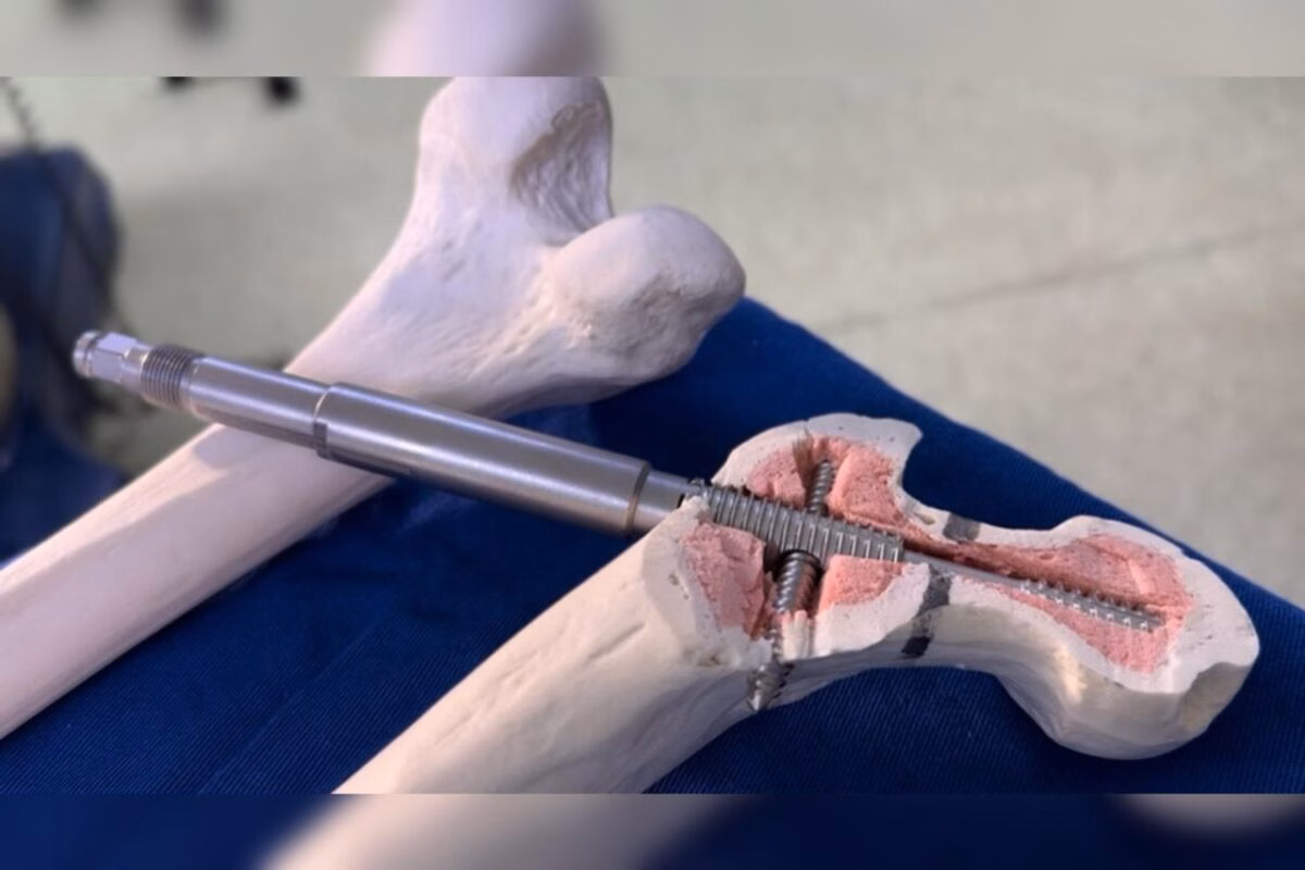 Implante inédito desenvolvido no Brasil melhora tratamento do fêmur
